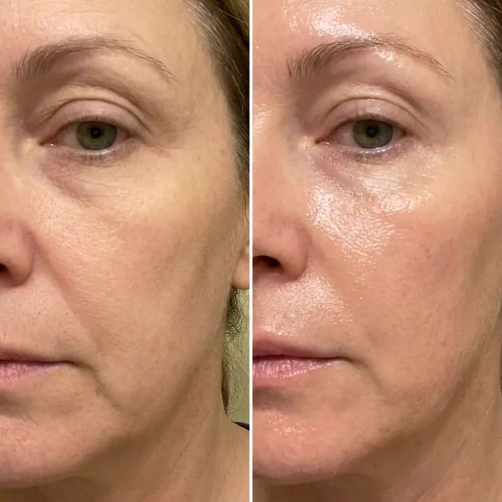 Denise M.: a close view of the skin under the eye and the cheek twice, smoother in the second
